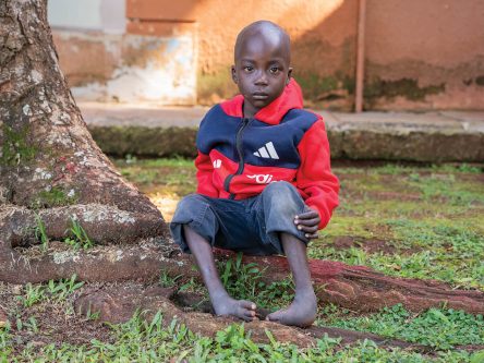 Help Straighten a Child’s Painful Clubfoot